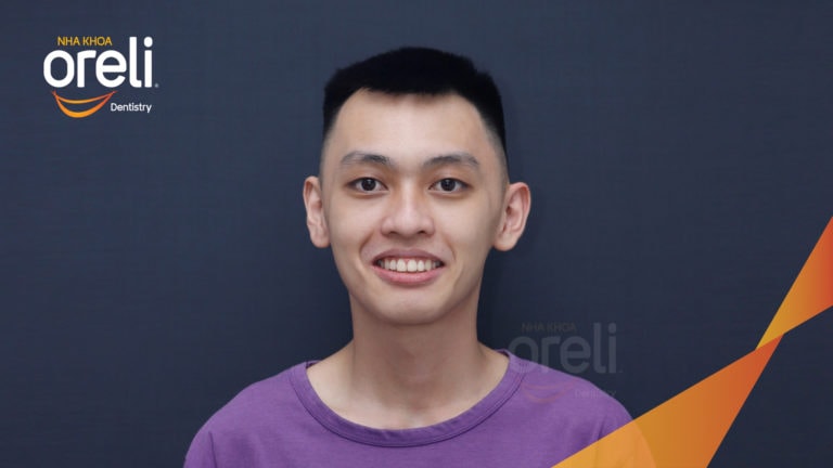 Ca niềng chỉnh hô nặng thay đổi nụ cười hoàn toàn kết quả sau 3 năm ở Oreli