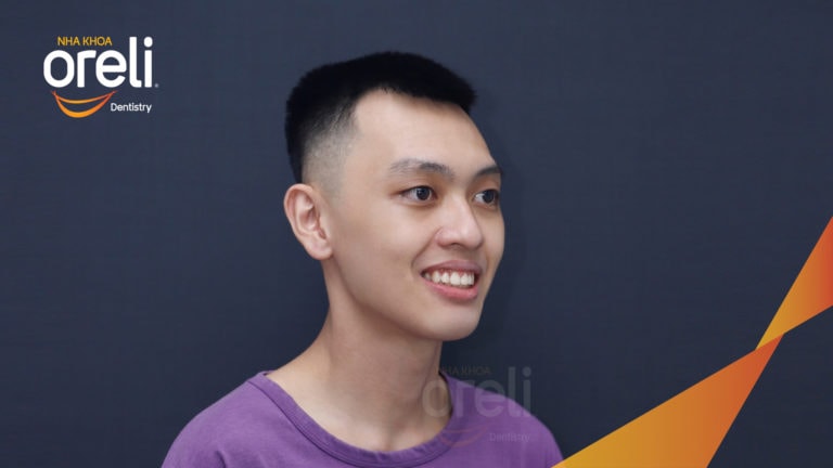 Ca niềng chỉnh hô nặng thay đổi nụ cười hoàn toàn kết quả sau 3 năm ở Oreli