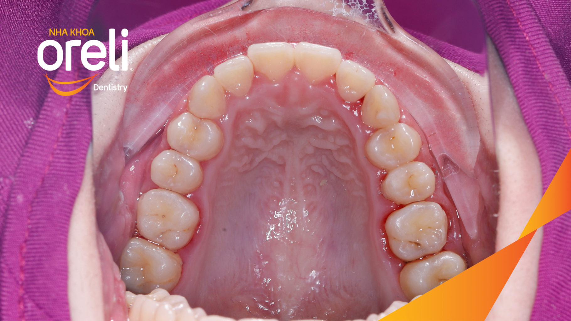 Thực hiện  kéo dài  tại Oreli