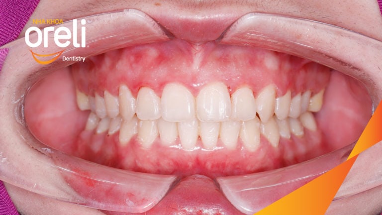 Ca niềng chỉnh chen chúc hẹp hàm kết quả điều trị thực tế tại Oreli