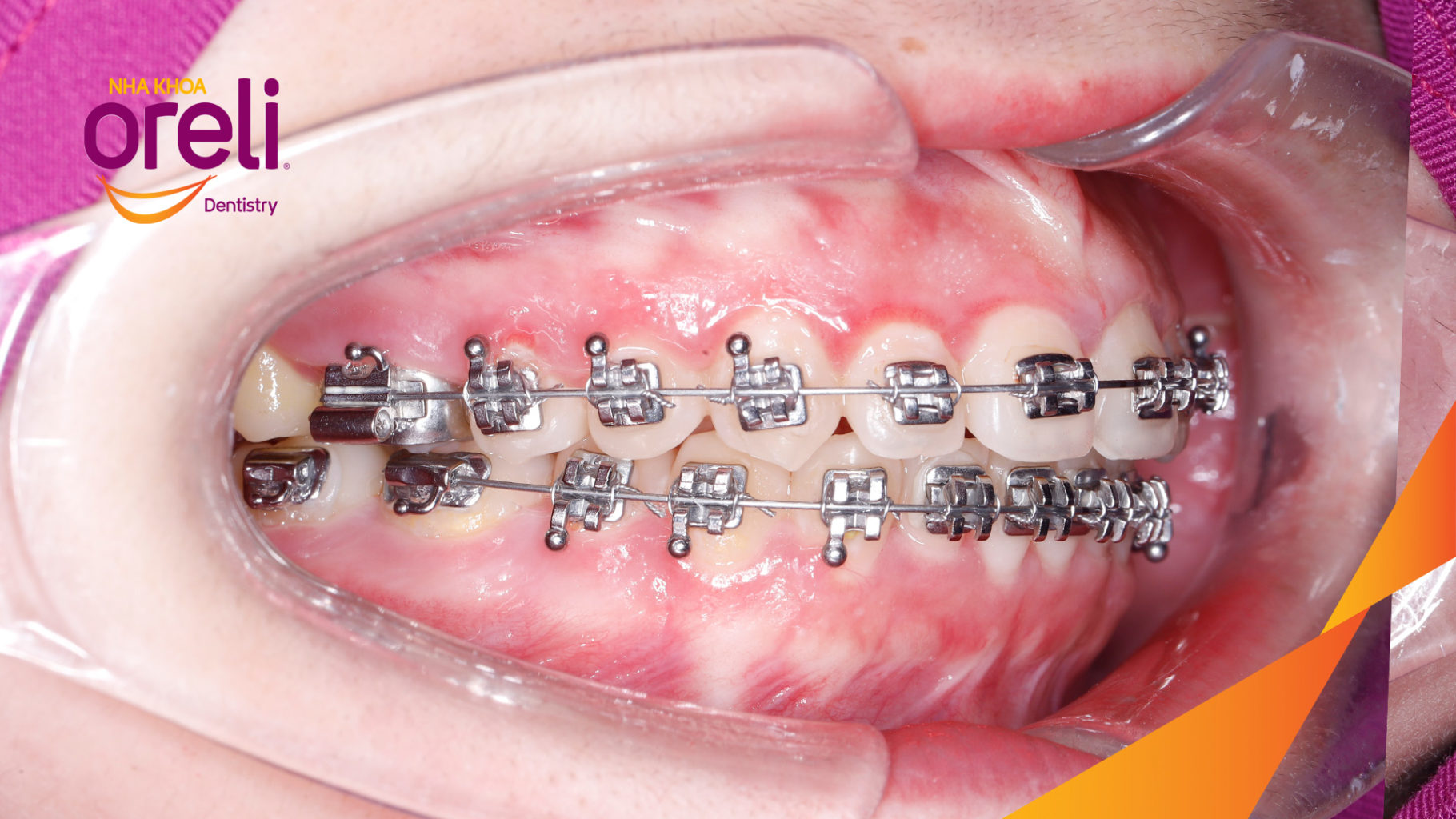 Kết quả đạt được sau  -  tại Oreli