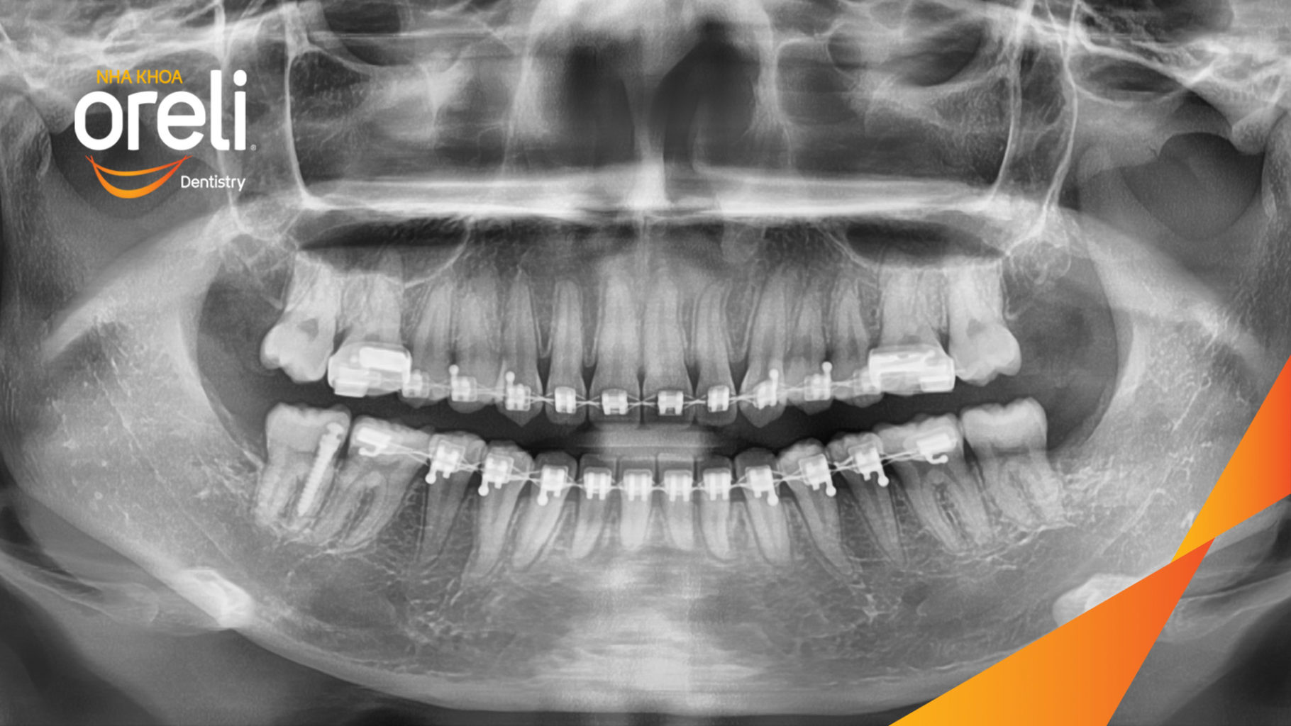 Kết quả đạt được sau  -  tại Oreli