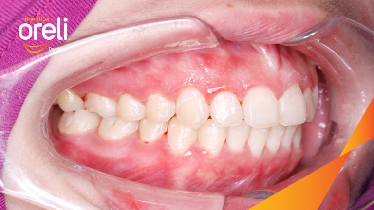 Ca niềng chỉnh chen chúc hẹp hàm kết quả điều trị thực tế tại Oreli