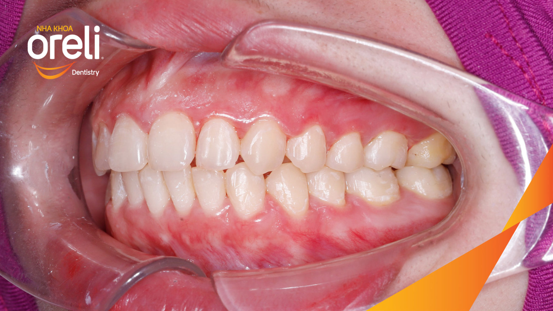 trước khi điều trị tại Oreli
