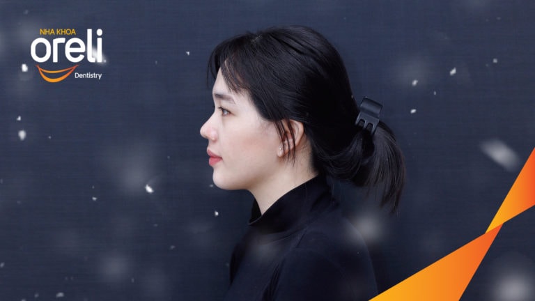Ca niềng chỉnh chen chúc hẹp hàm kết quả điều trị thực tế tại Oreli