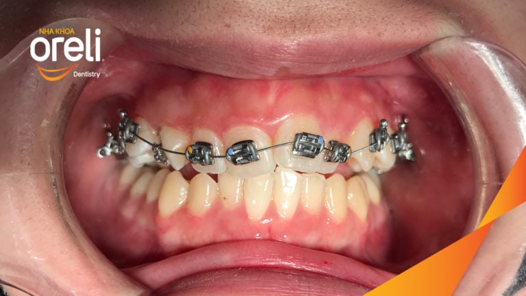 Ca niềng chỉnh chen chúc hẹp hàm kết quả điều trị thực tế tại Oreli