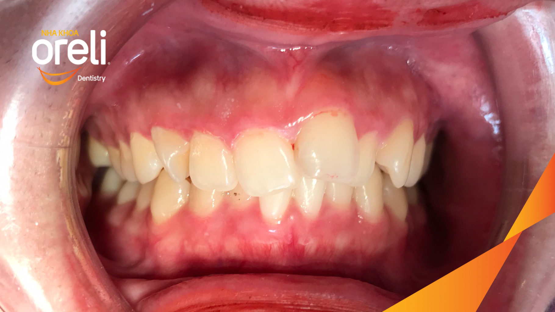 Trước điều trị:  tại Oreli