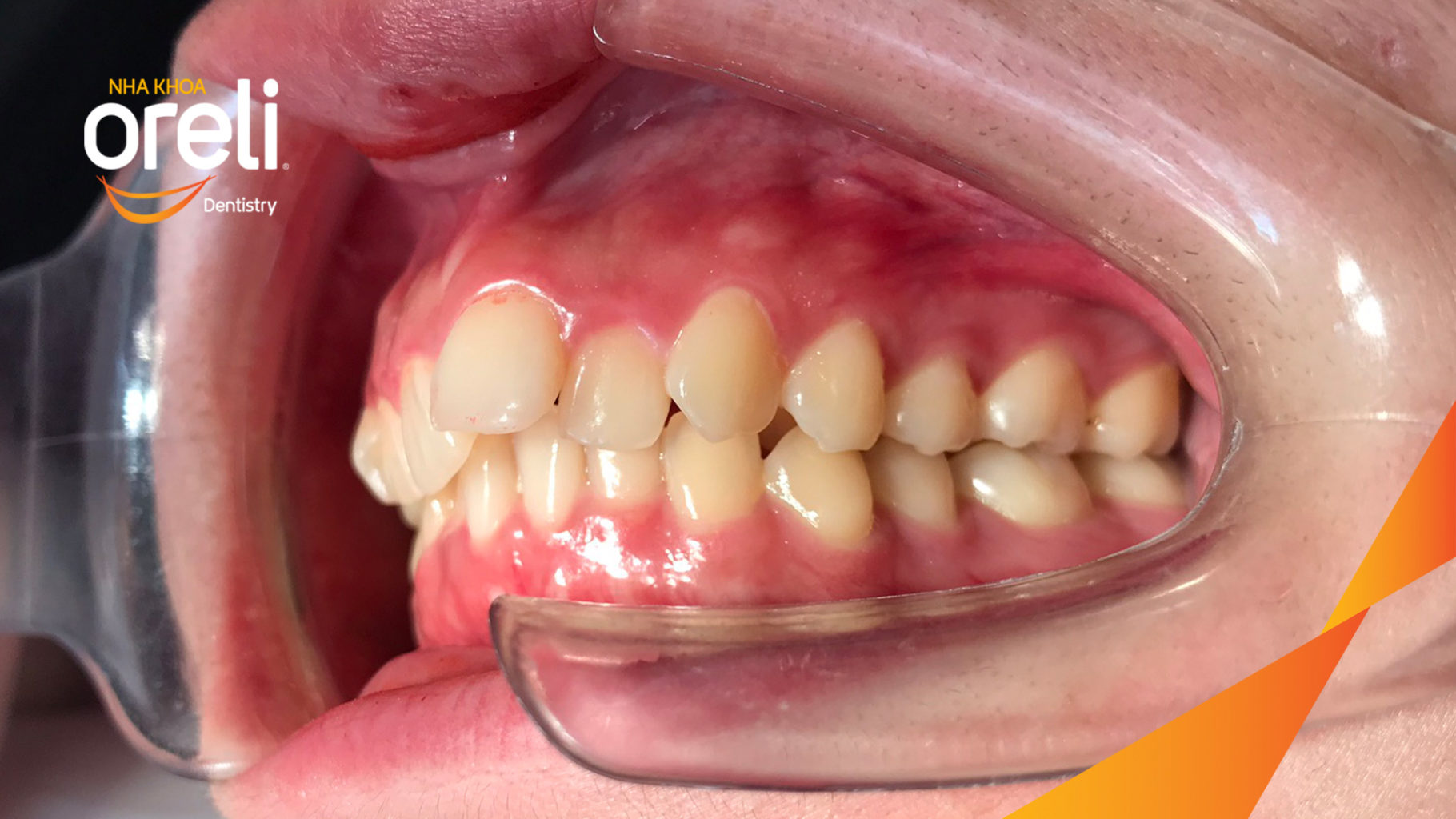 Trước điều trị:  tại Oreli