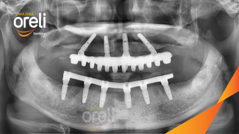 Case Implant hai hàm – Khôi phục răng mất, cải thiện thẩm mỹ | Oreli
