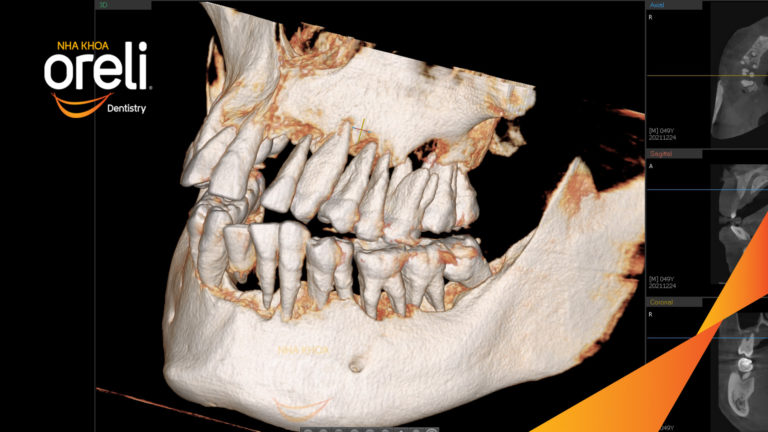 Case Implant hai hàm – Khôi phục răng mất, cải thiện thẩm mỹ | Oreli