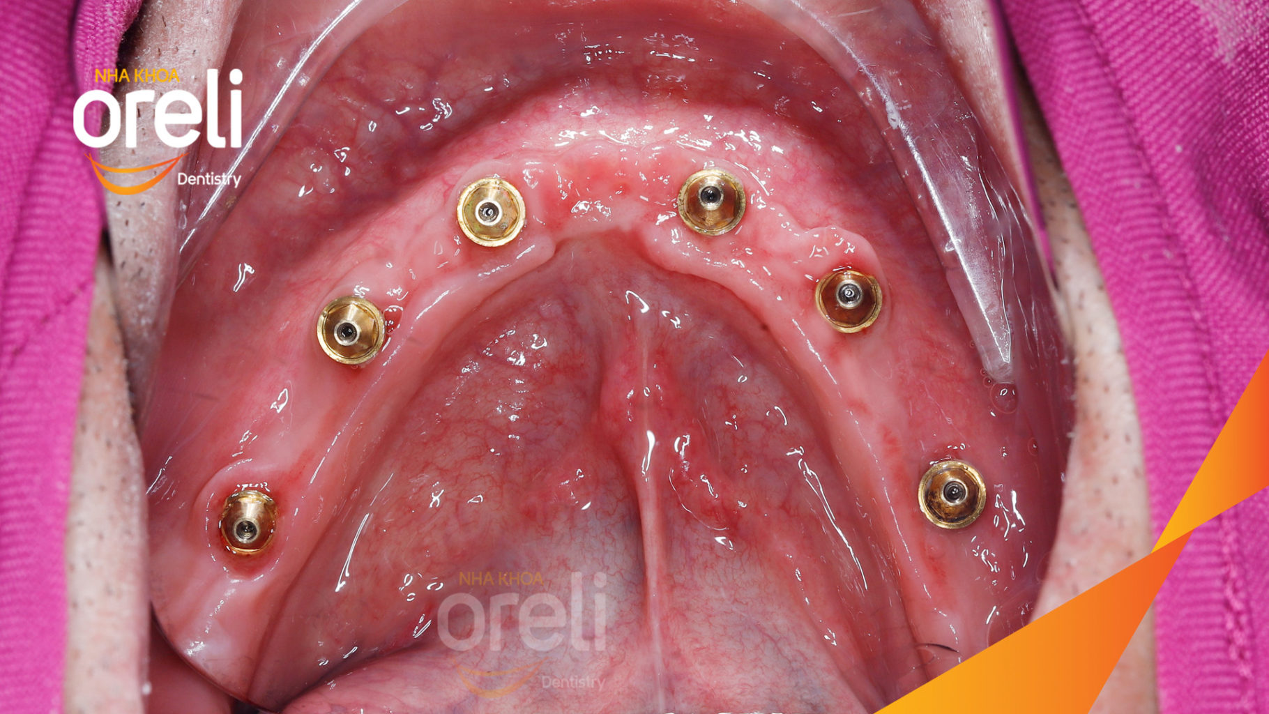 cay ghep implant oreli