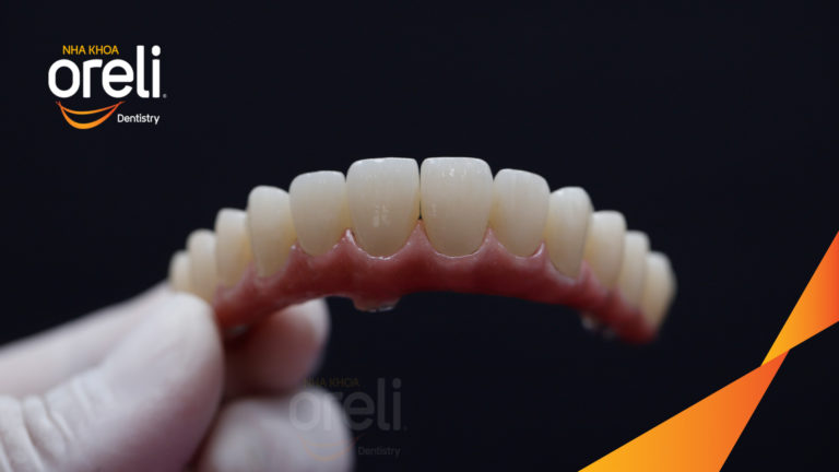 Case Implant hai hàm – Khôi phục răng mất, cải thiện thẩm mỹ | Oreli
