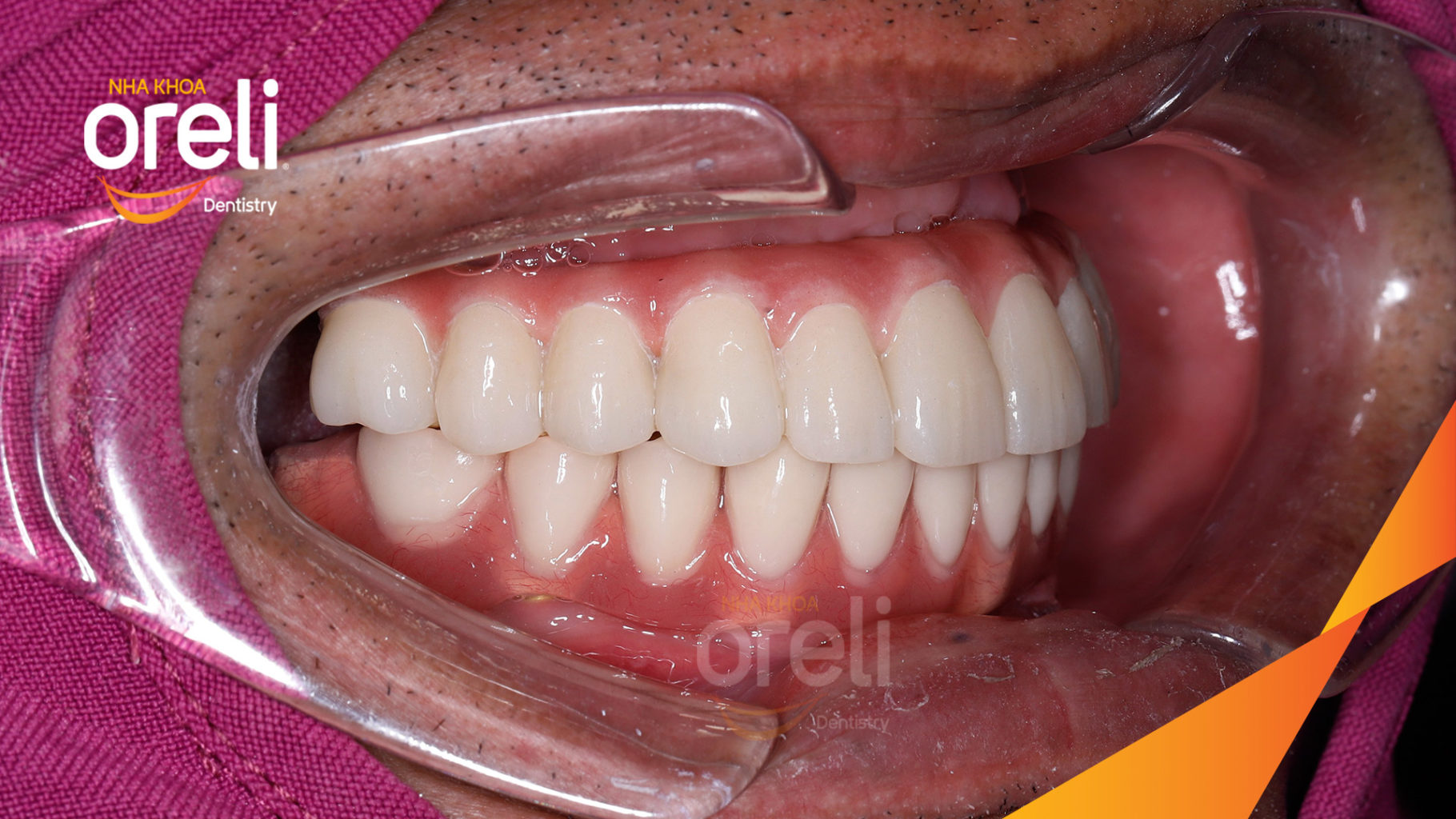 cay ghep implant oreli