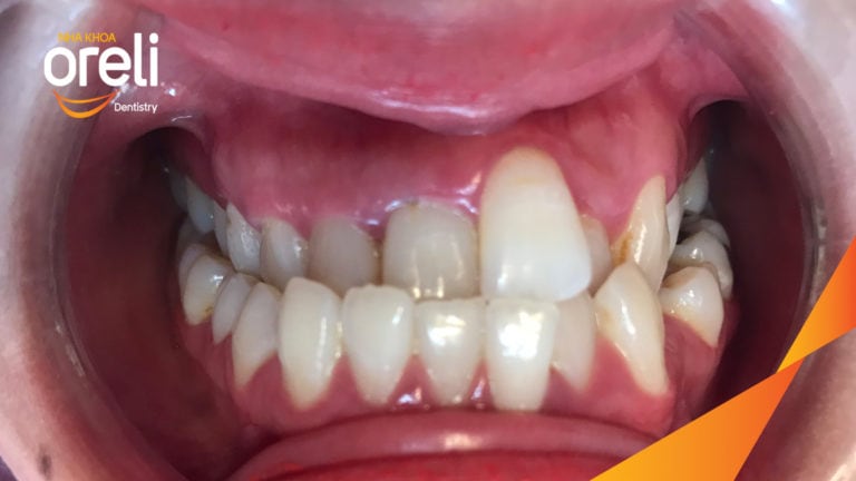 Chỉnh hạng 3 móm nặng di xa toàn hàm không nhổ răng – Kết quả thực tế tại Oreli