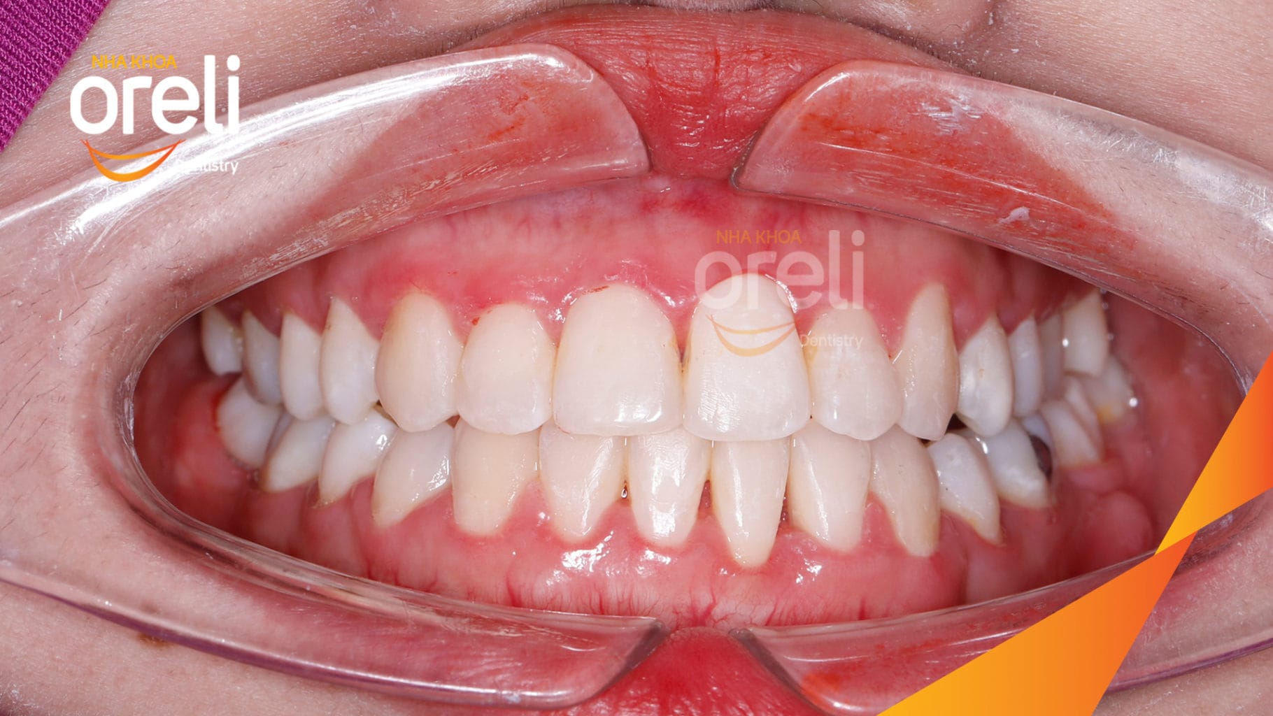 Chỉnh hạng 3 móm nặng di xa toàn hàm không nhổ răng – Kết quả thực tế tại Oreli