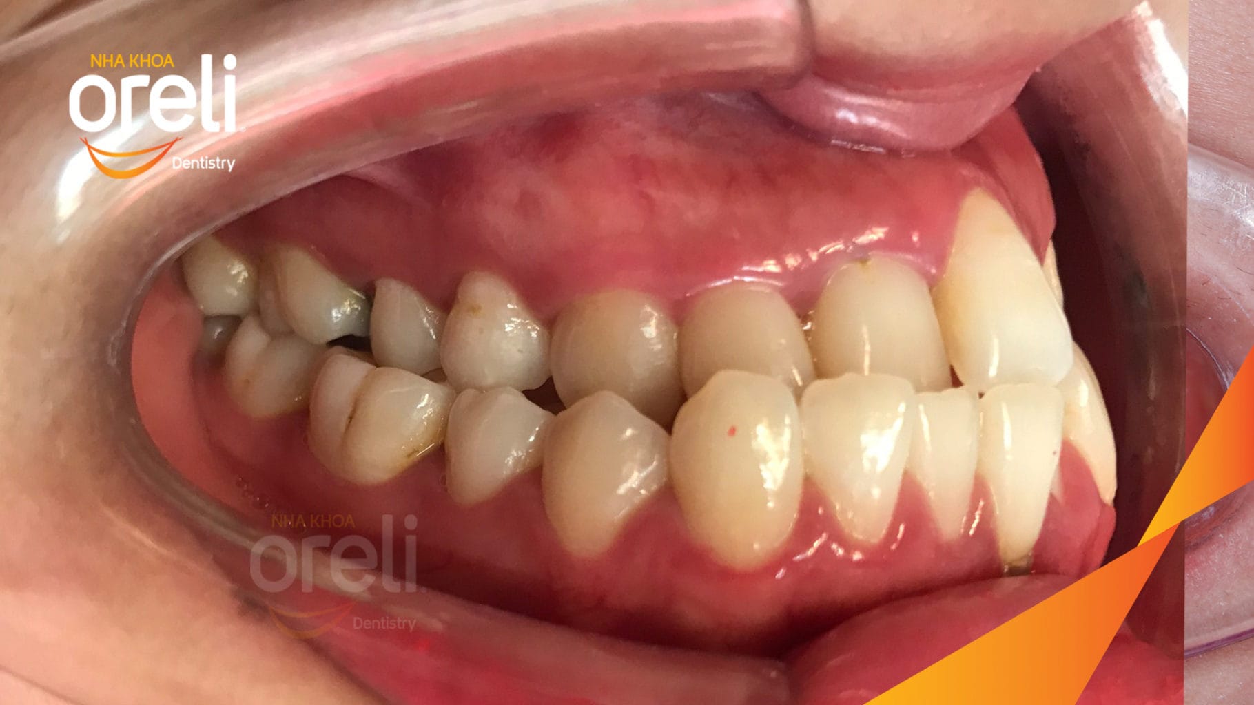 Chỉnh hạng 3 móm nặng di xa toàn hàm không nhổ răng – Kết quả thực tế tại Oreli