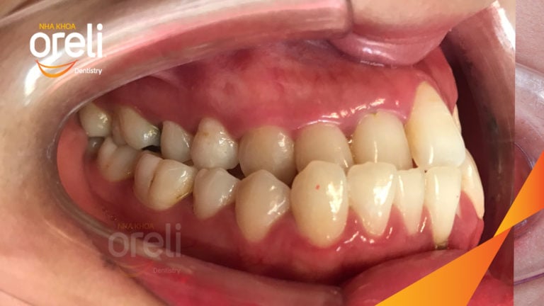 Chỉnh hạng 3 móm nặng di xa toàn hàm không nhổ răng – Kết quả thực tế tại Oreli