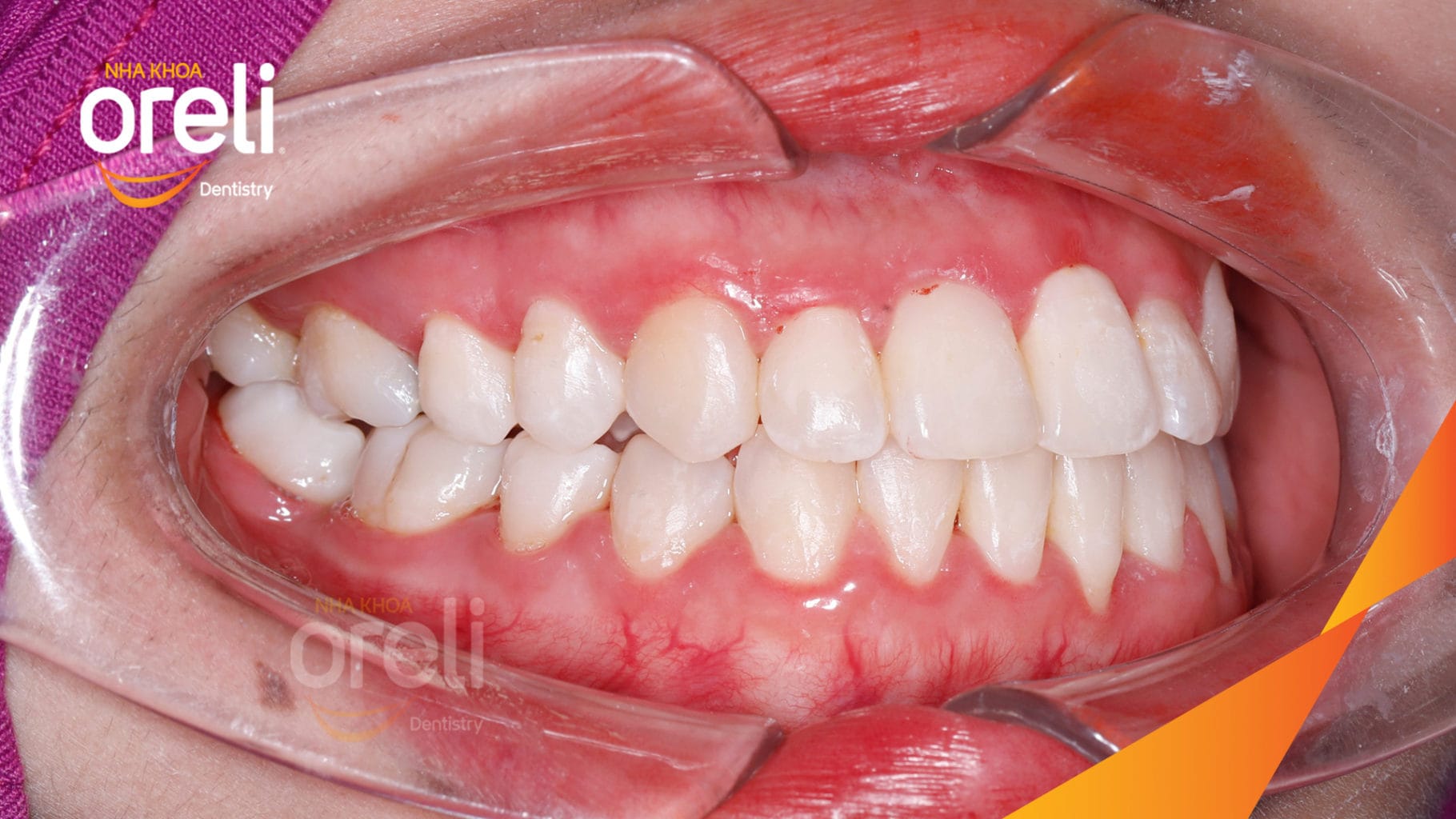 Chỉnh hạng 3 móm nặng di xa toàn hàm không nhổ răng – Kết quả thực tế tại Oreli