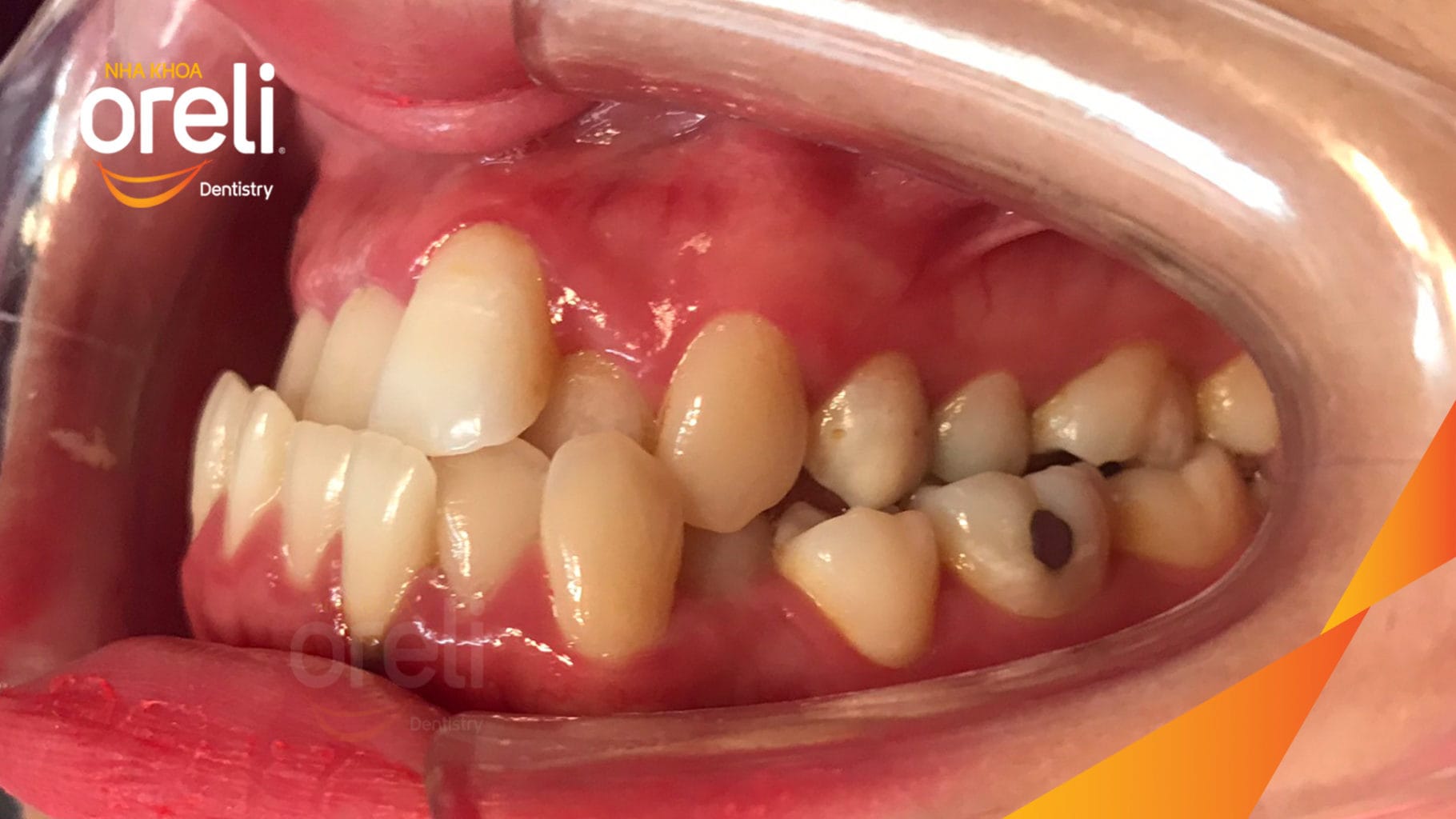 Chỉnh hạng 3 móm nặng di xa toàn hàm không nhổ răng – Kết quả thực tế tại Oreli