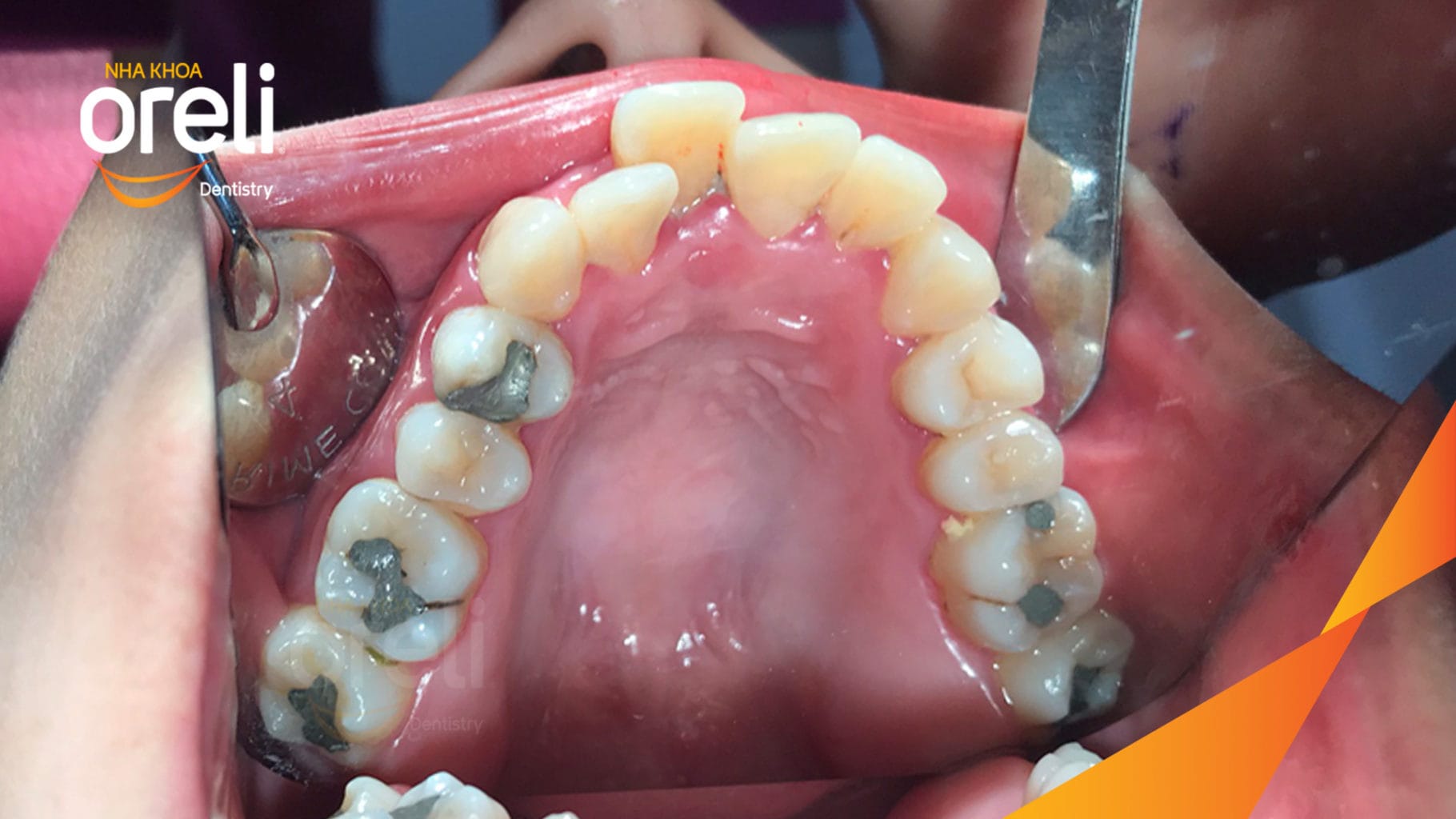 Chỉnh hạng 3 móm nặng di xa toàn hàm không nhổ răng – Kết quả thực tế tại Oreli