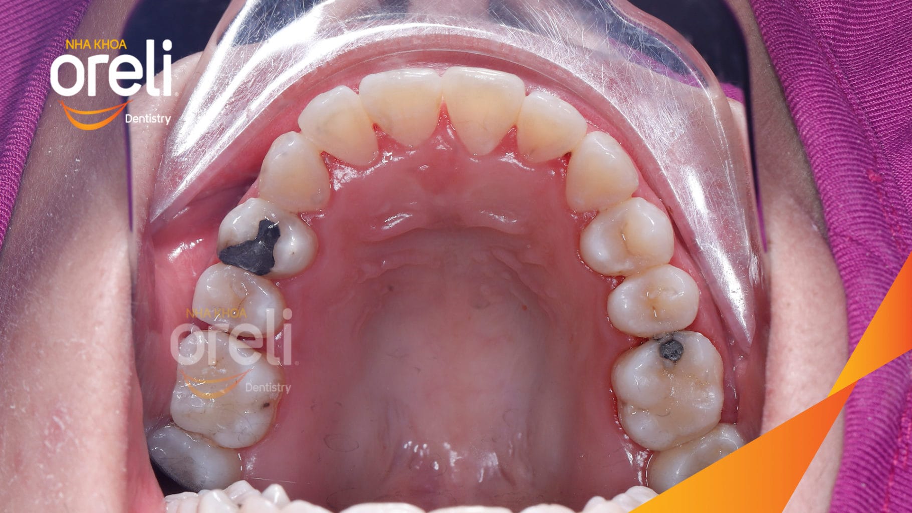 Chỉnh hạng 3 móm nặng di xa toàn hàm không nhổ răng – Kết quả thực tế tại Oreli