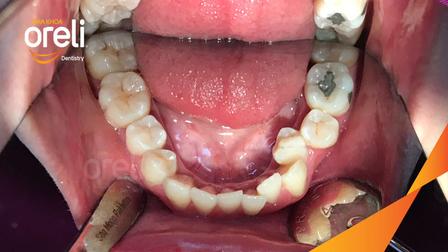 Quá trình  trong  tại Oreli