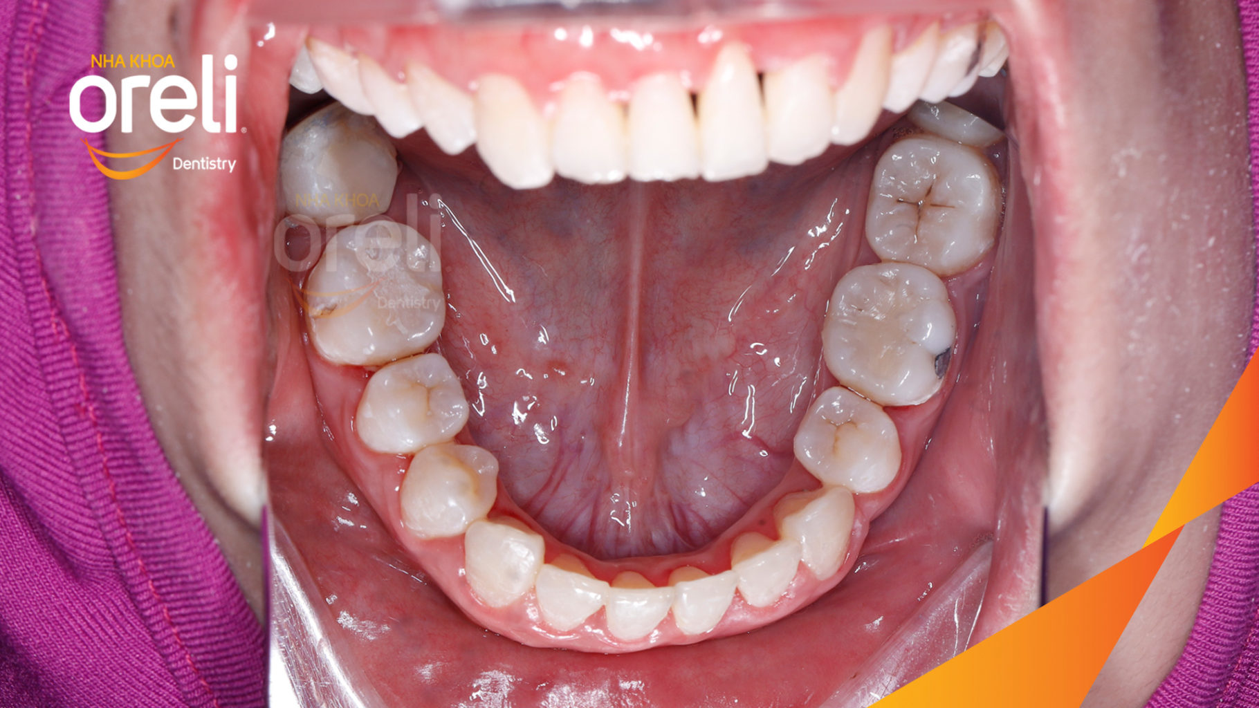 Thực hiện  kéo dài  tại Oreli