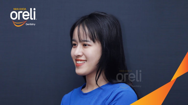 Chỉnh hạng 3 móm nặng di xa toàn hàm không nhổ răng – Kết quả thực tế tại Oreli