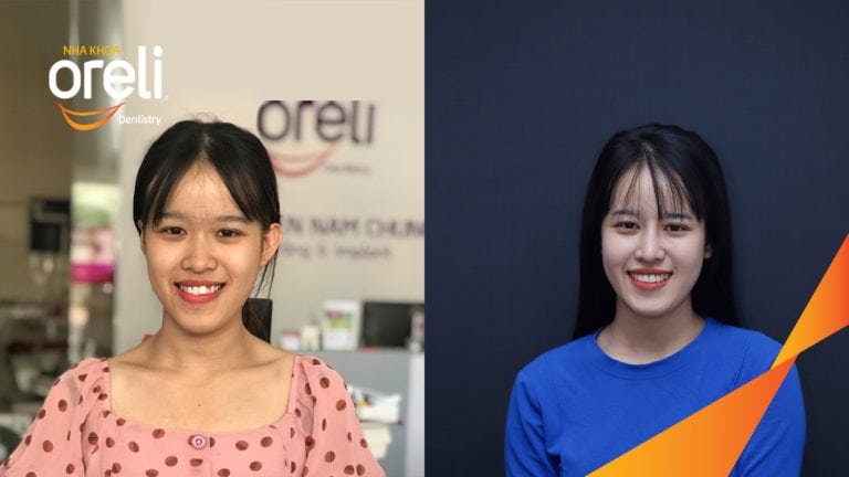 nieng rang sai khop can hang 3 Oreli