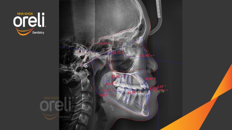 Ca niềng chỉnh hạng 3 móm nặng với kỹ thuật GEAW- Kết quả sau 24 tháng tại Oreli
