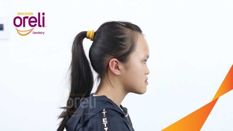 Ca niềng chỉnh hạng 3 móm nặng với kỹ thuật GEAW- Kết quả sau 24 tháng tại Oreli