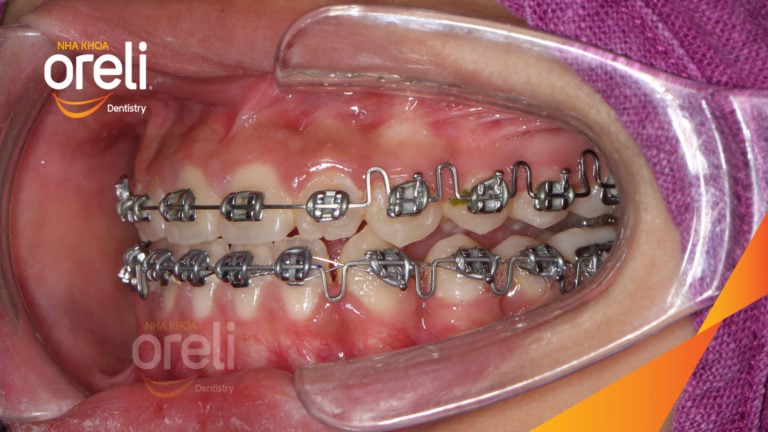 Ca niềng chỉnh hạng 3 móm nặng với kỹ thuật GEAW- Kết quả sau 24 tháng tại Oreli