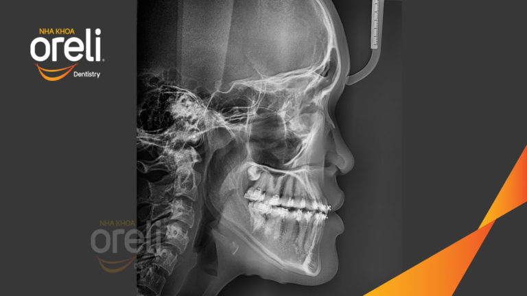 Ca niềng chỉnh hạng 3 móm nặng với kỹ thuật GEAW- Kết quả sau 24 tháng tại Oreli