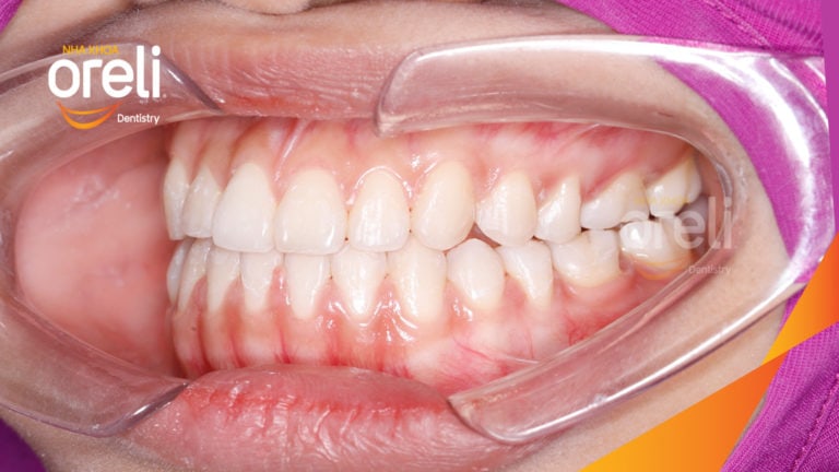 Ca chỉnh móm nặng không nhổ răng cho nụ cười đẹp và khớp cắn đúng tại Oreli