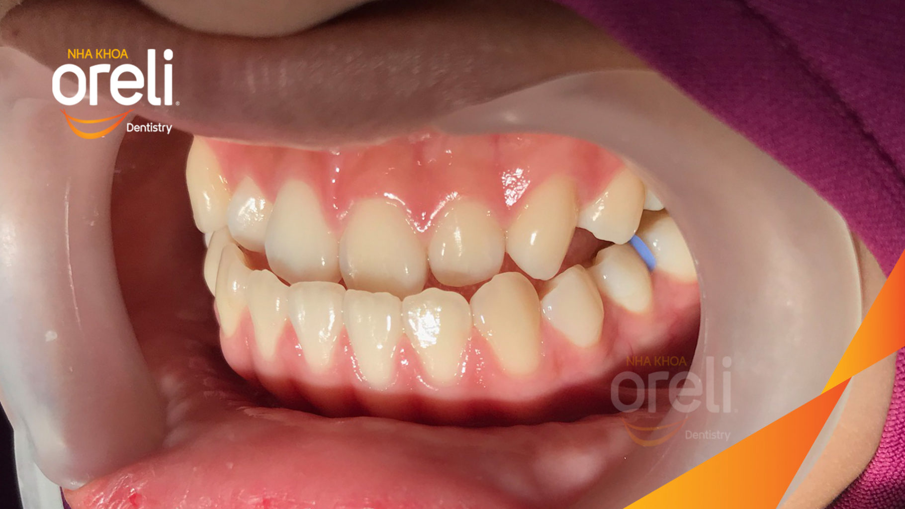 nieng rang uy tin bmt daklak