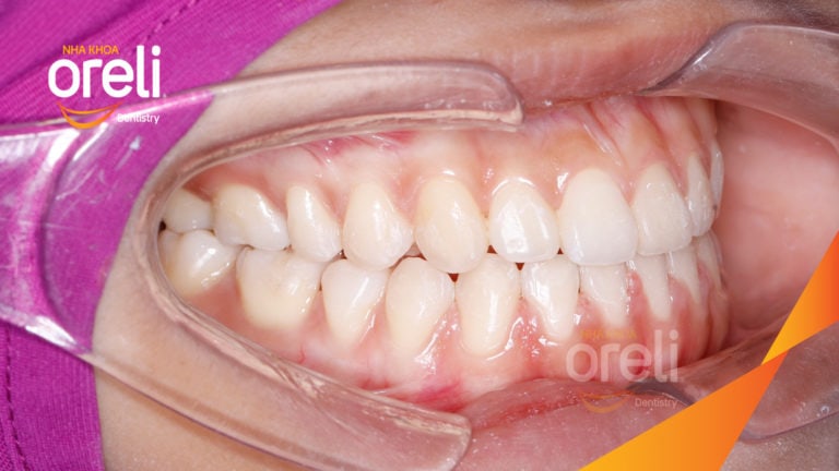 Ca chỉnh móm nặng không nhổ răng cho nụ cười đẹp và khớp cắn đúng tại Oreli