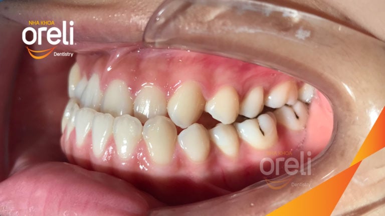 Ca chỉnh móm nặng không nhổ răng cho nụ cười đẹp và khớp cắn đúng tại Oreli