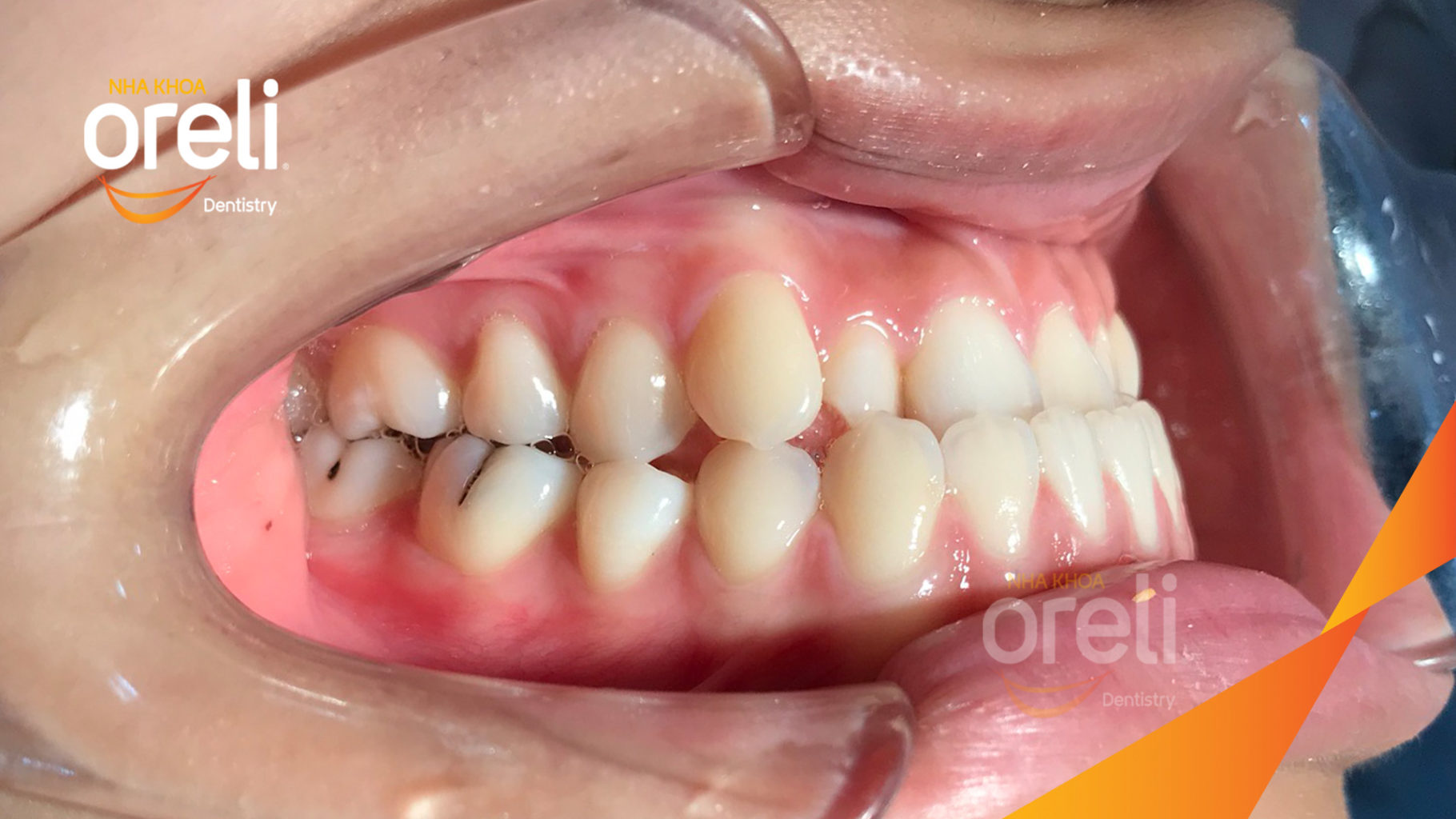 nieng rang uy tin bmt daklak