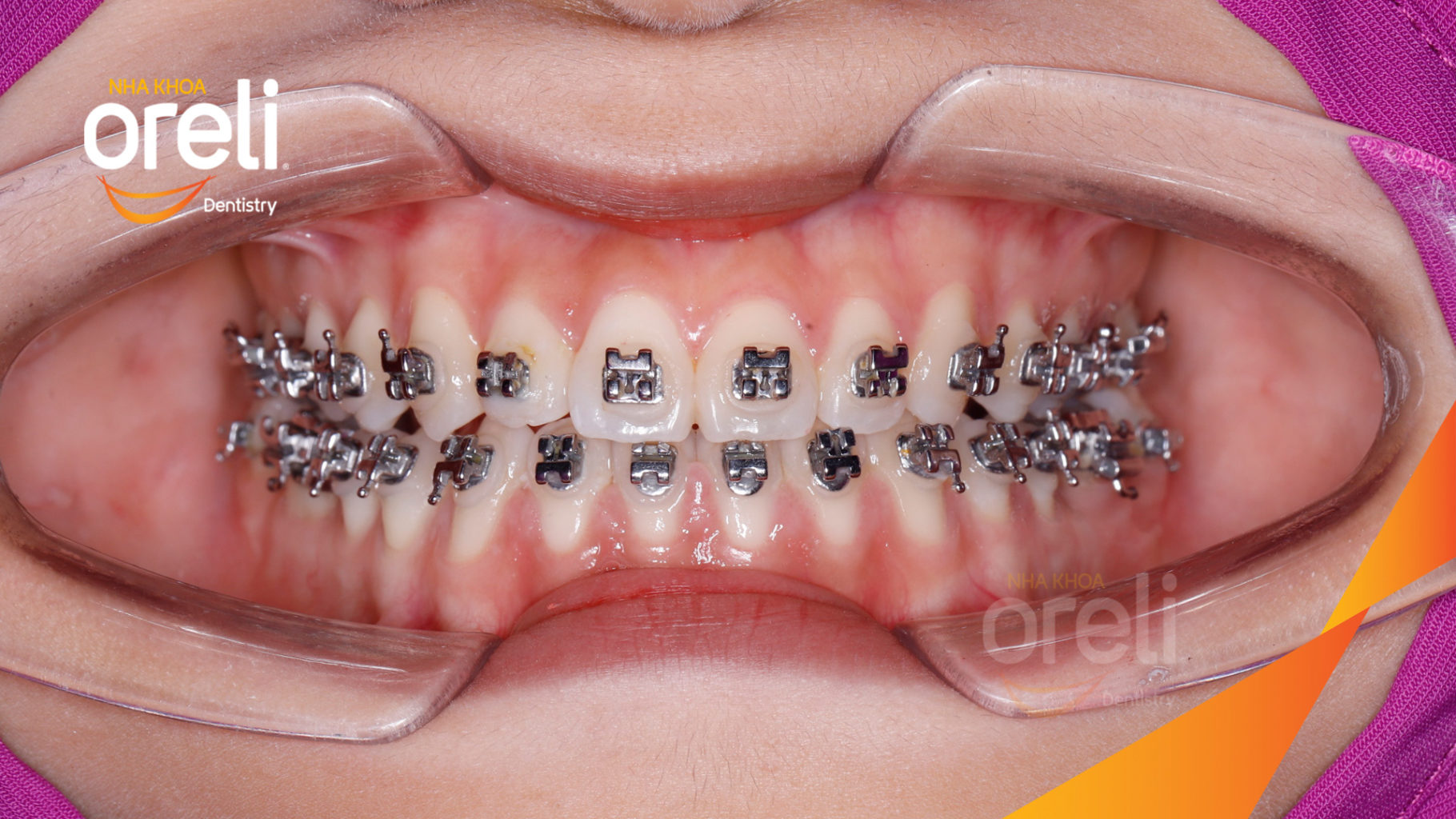 nieng rang uy tin bmt daklak