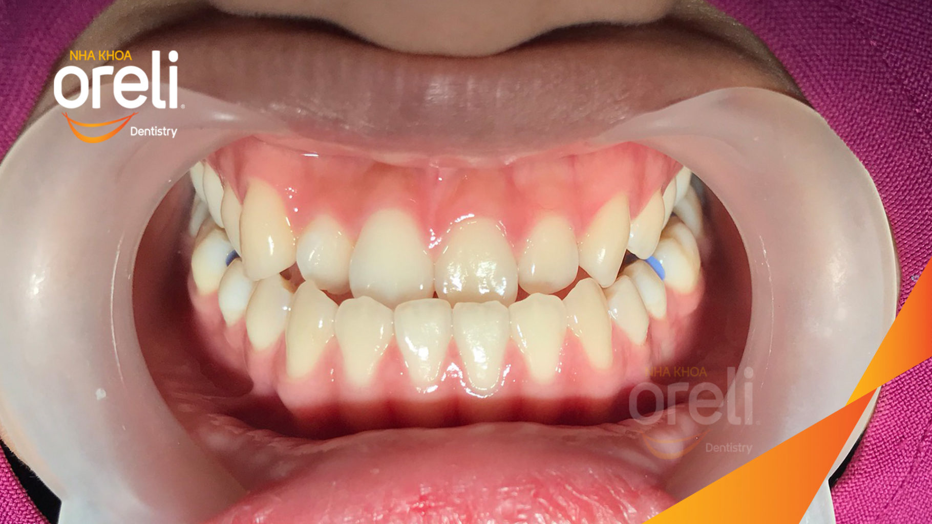 nieng rang uy tin bmt daklak