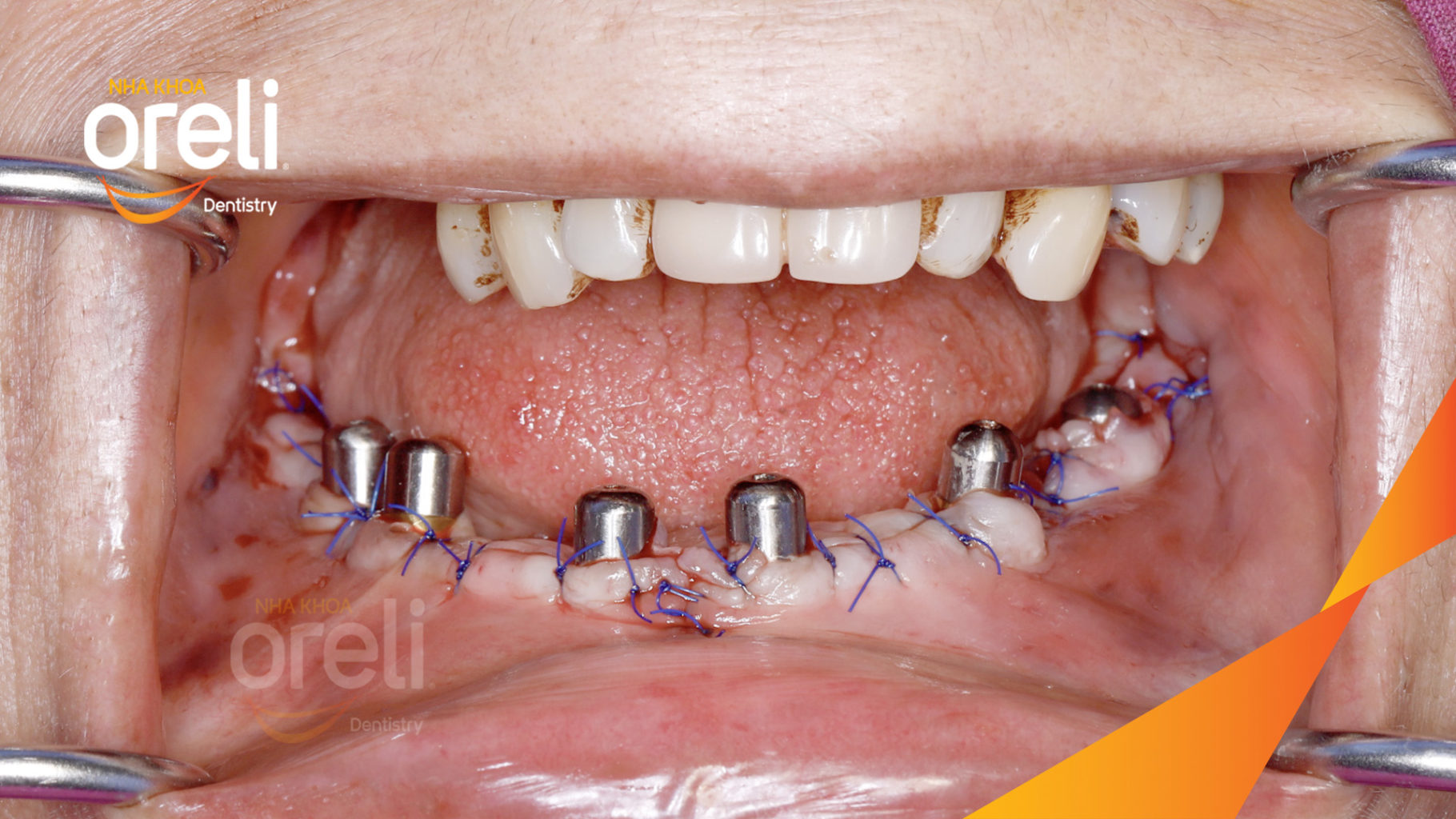 cay ghep implant toan ham oreli bmt