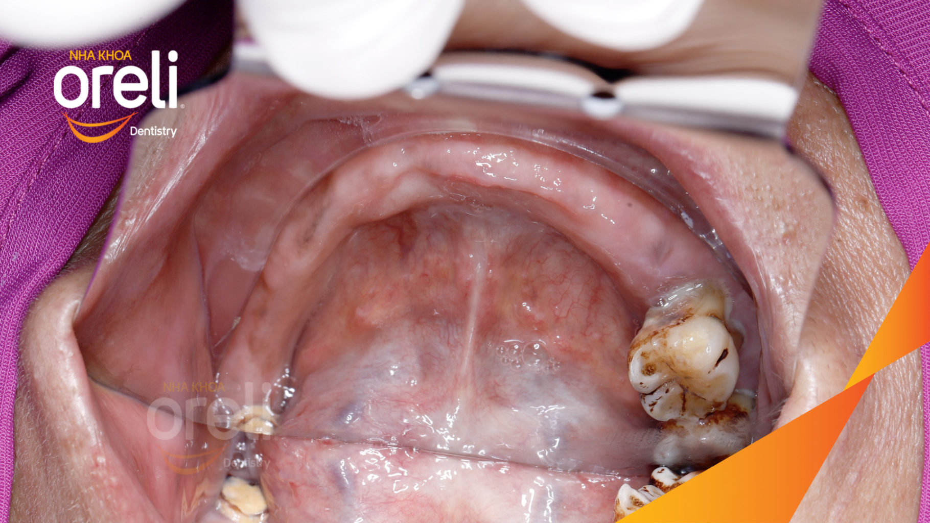 cay ghep implant toan ham oreli bmt