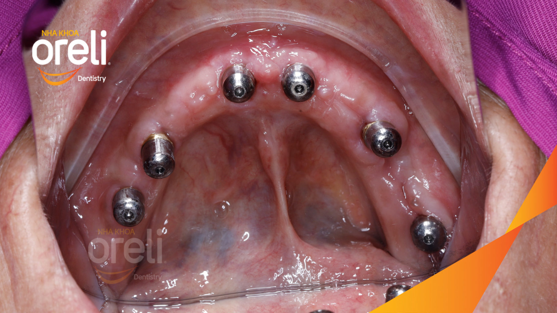 cay ghep implant toan ham oreli bmt