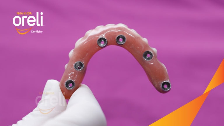 cay ghep implant toan ham oreli bmt