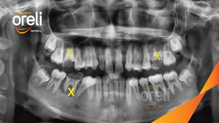 Ca niềng răng đặc biệt: kéo răng 7, 8 thay thế 3 răng 6 bị hư tại Oreli