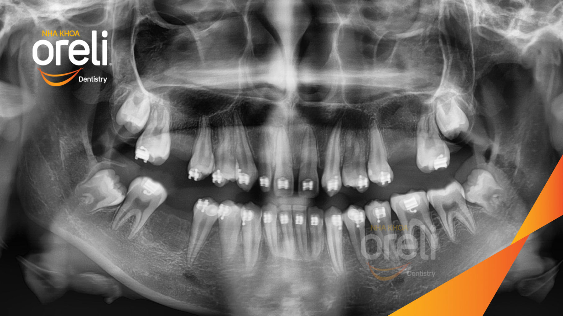 Kết quả sau :  tại Oreli