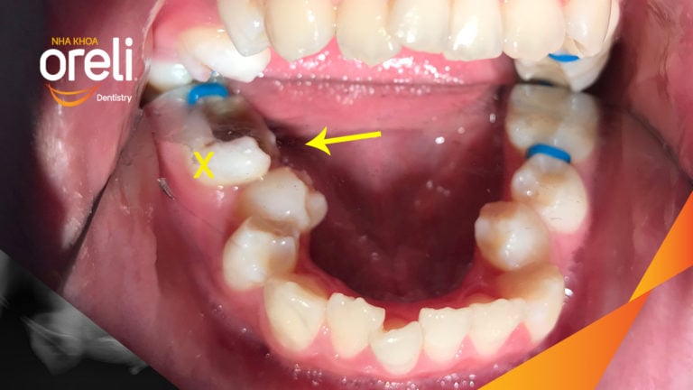 Ca niềng răng đặc biệt: kéo răng 7, 8 thay thế 3 răng 6 bị hư tại Oreli