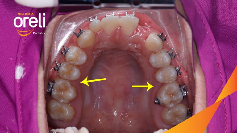 Ca niềng răng đặc biệt: kéo răng 7, 8 thay thế 3 răng 6 bị hư tại Oreli