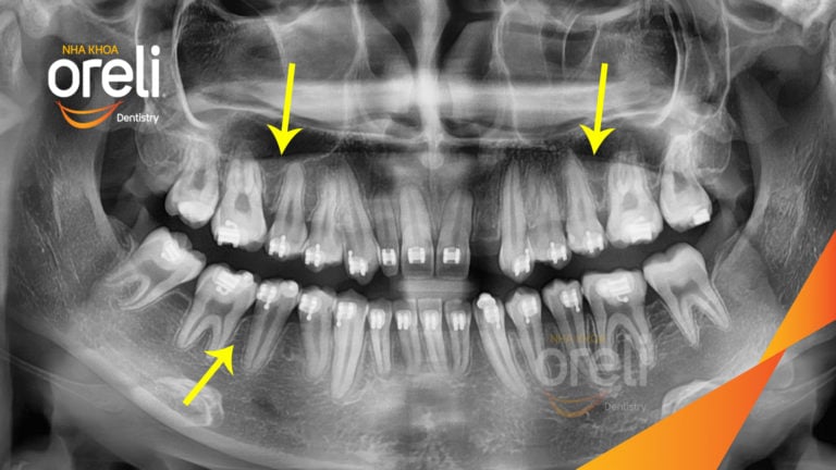 Ca niềng răng đặc biệt: kéo răng 7, 8 thay thế 3 răng 6 bị hư tại Oreli