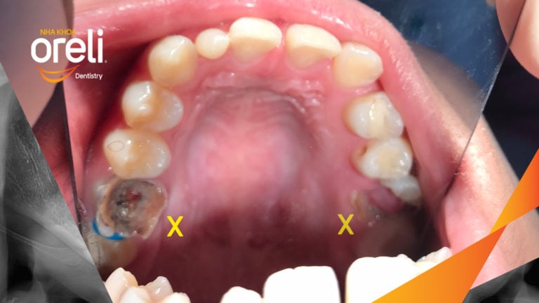 Ca niềng răng đặc biệt: kéo răng 7, 8 thay thế 3 răng 6 bị hư tại Oreli